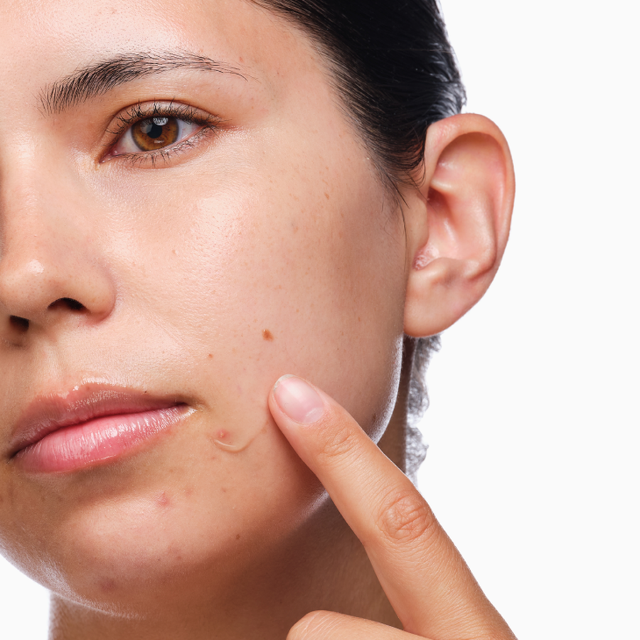 the-acne-set-p0 rdn-the-acne-set-application.png