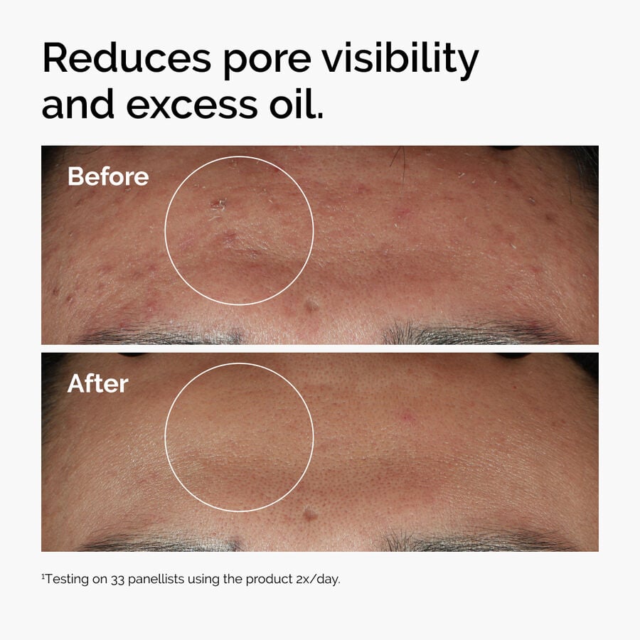 niacinamide-10-zinc-1-i8 ord-niacinamide-zinc-blemish-serum-before-after-pores.jpg